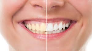 Online Teeth Whitening Chat, Teeth Staining Discussion, Online Teeth Whitening Blog, Teeth Sensitivity Chat